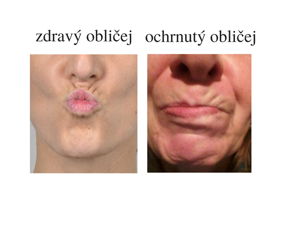 ochrnutý obličej